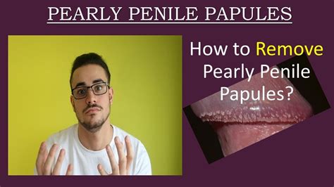 Penile Pearly Papules: Multiple white papules on the penis